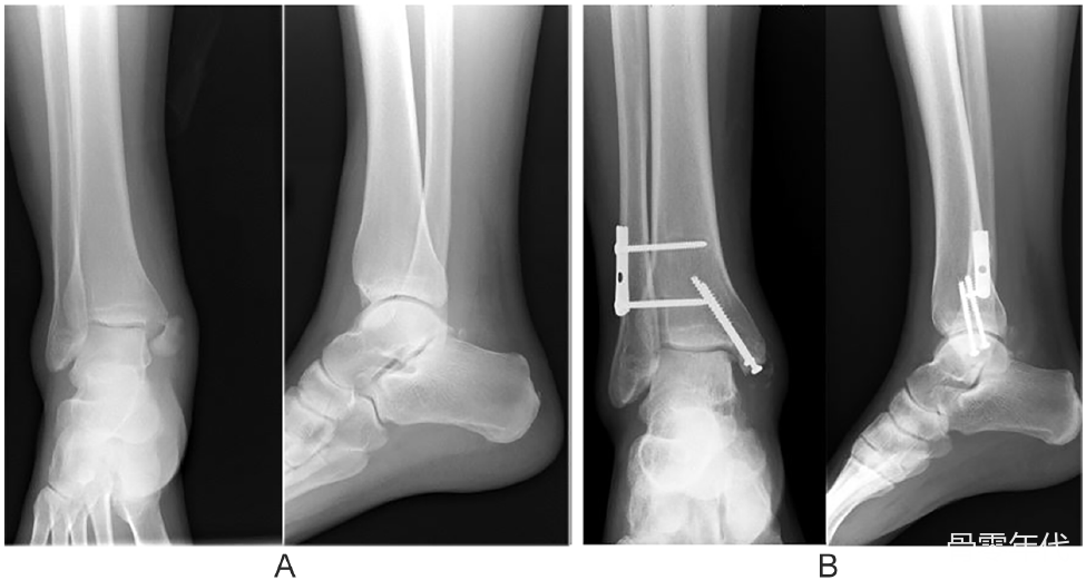单枚螺钉与两枚螺钉固定不稳定踝关节的内踝骨折