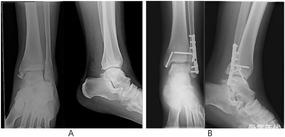 单枚螺钉与两枚螺钉固定不稳定踝关节的内踝骨折
