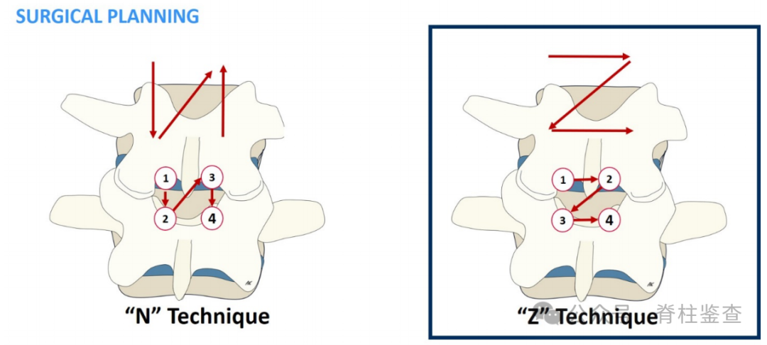 UBE手术治疗中央型腰椎管狭窄“Z”技术细节