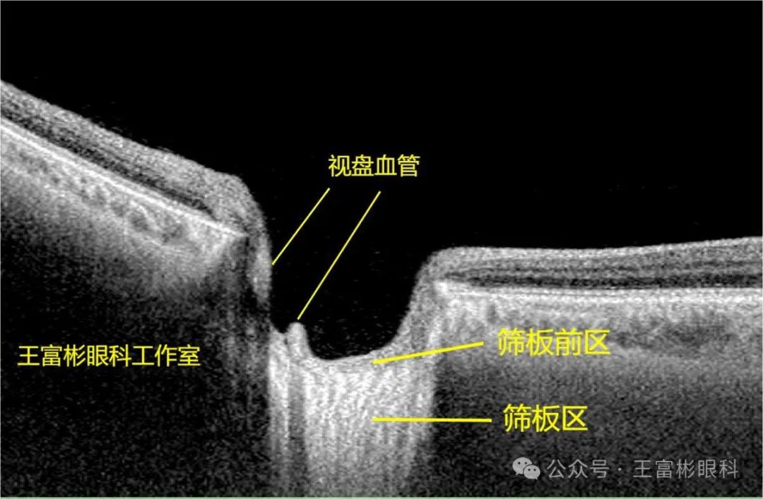 正常人“大杯/盘比”的OCT影像学解读