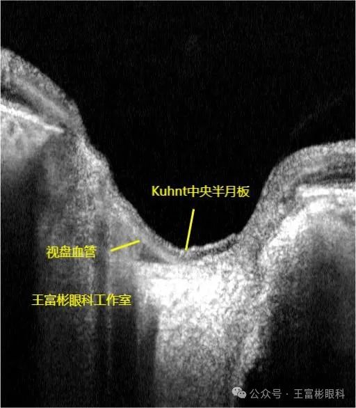 正常人“大杯/盘比”的OCT影像学解读