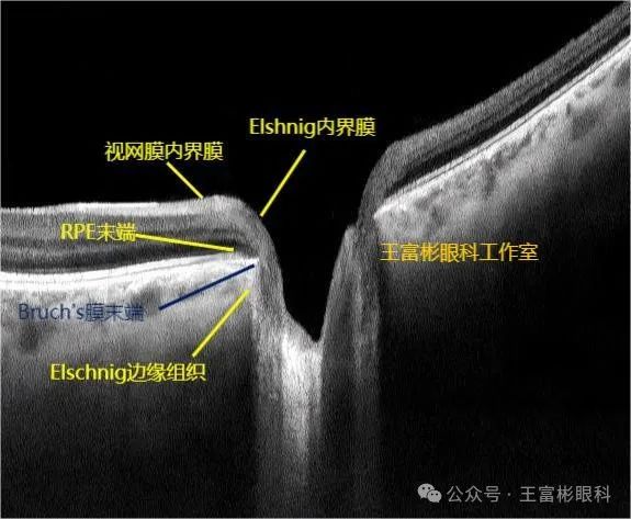 正常人“大杯/盘比”的OCT影像学解读