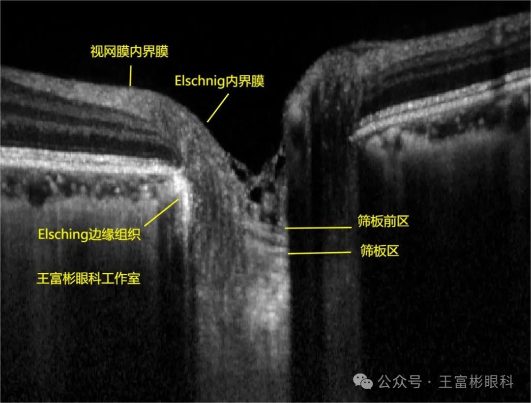 正常人“大杯/盘比”的OCT影像学解读