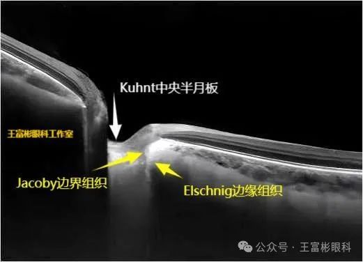 正常人“大杯/盘比”的OCT影像学解读