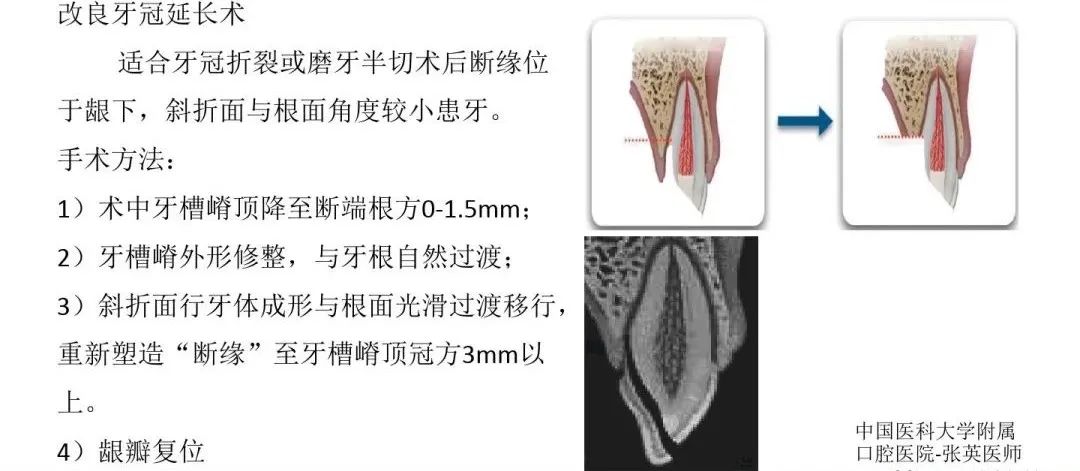 牙冠延长术具体操作，看完这篇就学会！