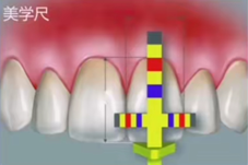 牙冠延长术具体操作，看完这篇就学会！