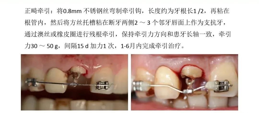 牙冠延长术具体操作，看完这篇就学会！