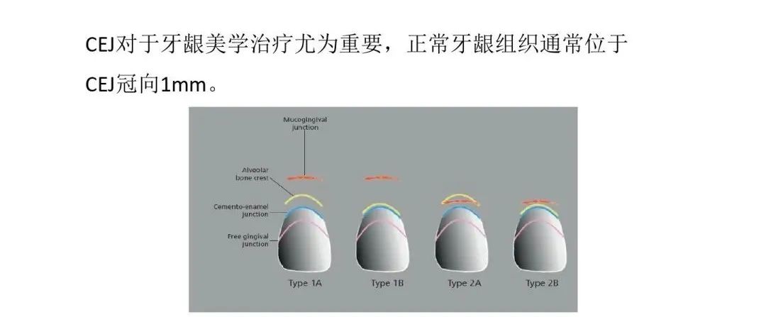 牙冠延长术具体操作，看完这篇就学会！