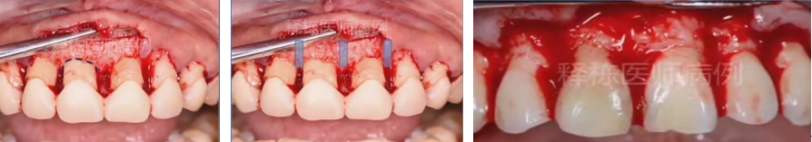 牙冠延长术具体操作，看完这篇就学会！