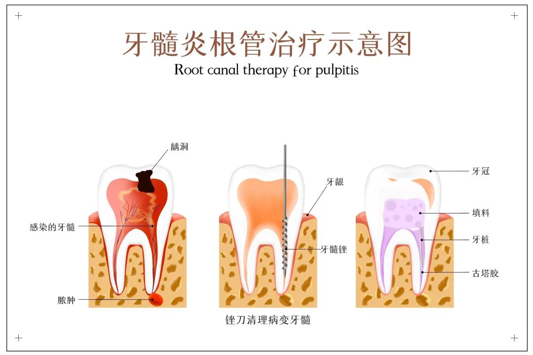 智齿碰上急性牙髓炎，直接拔除还是开髓后拔除？