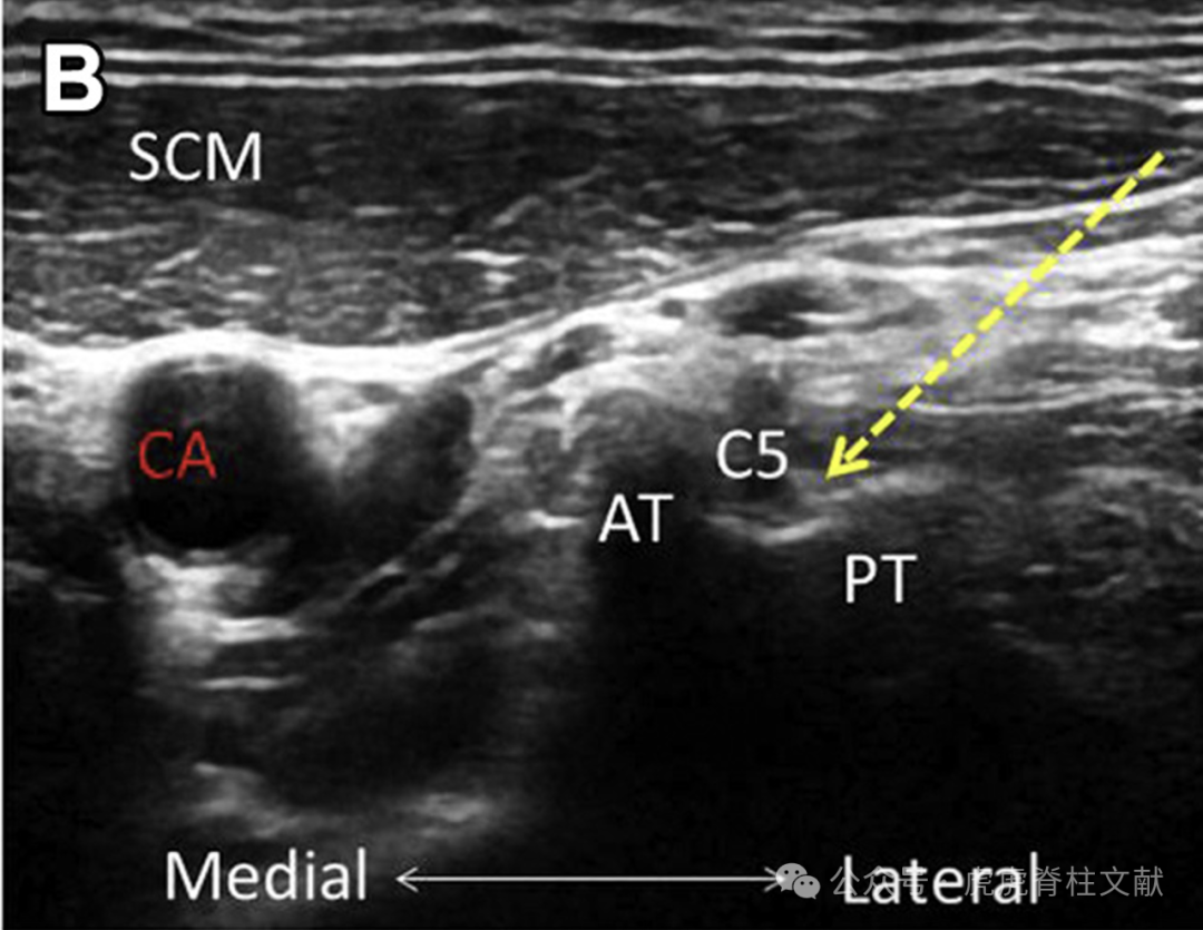 超声引导下颈椎介入技术图谱（一）：C5-7颈神经根