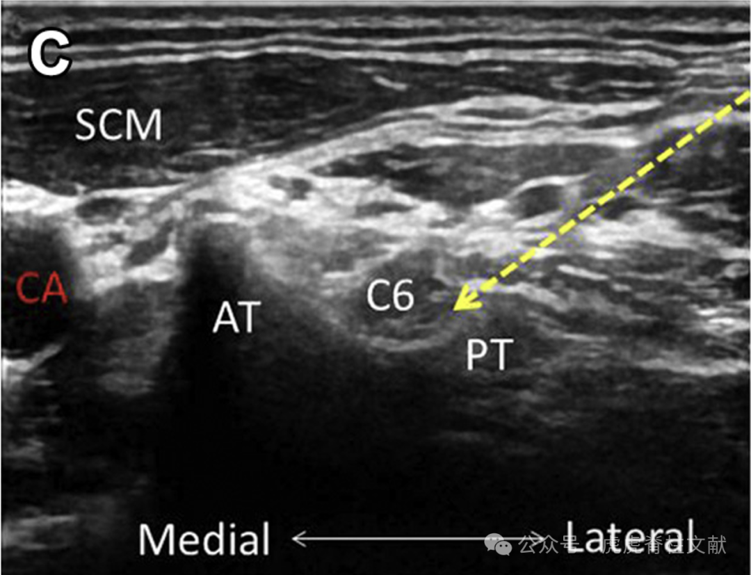 超声引导下颈椎介入技术图谱（一）：C5-7颈神经根