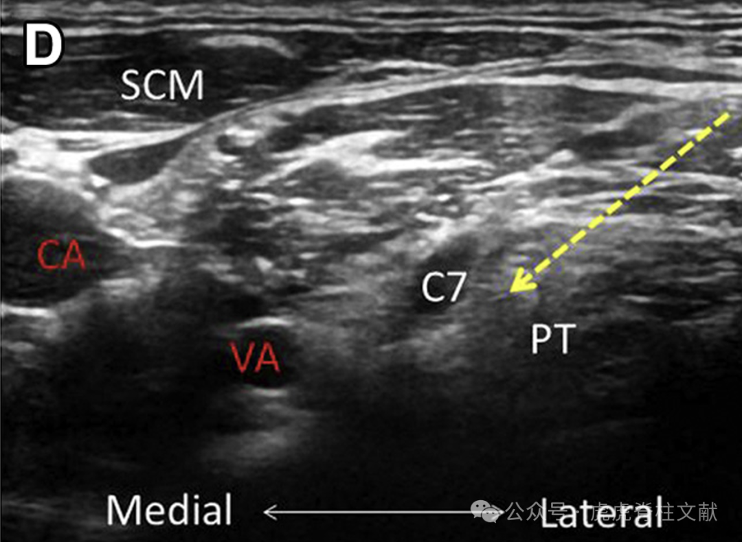 超声引导下颈椎介入技术图谱（一）：C5-7颈神经根