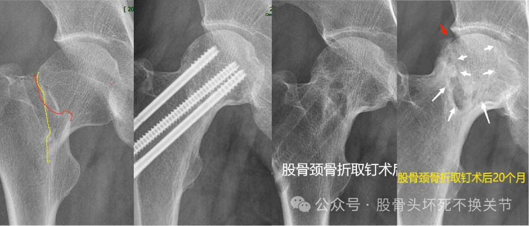 股骨颈骨折：步步为坑，你还在踩吗？