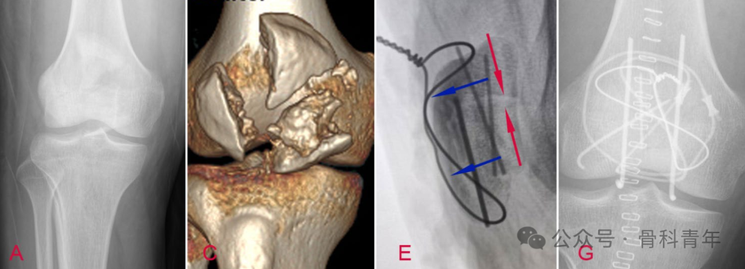 “张力带优先”法内固定治疗髌骨粉碎性骨折（C3型）