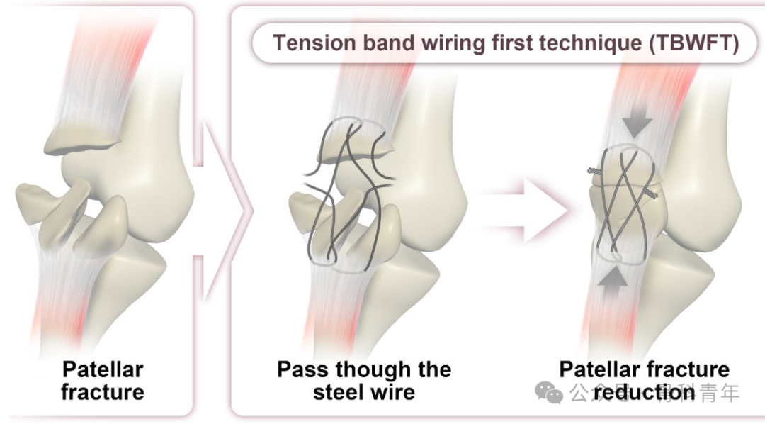 “张力带优先”法内固定治疗髌骨粉碎性骨折（C3型）