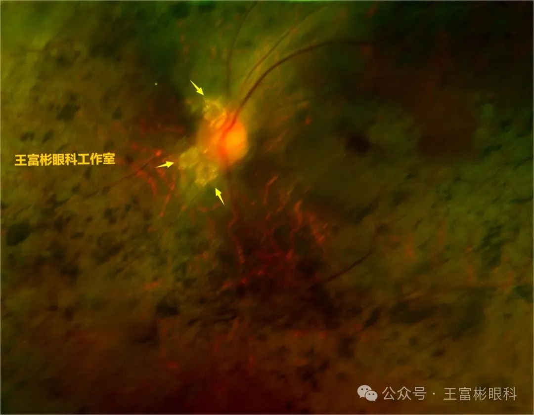 视盘玻璃膜疣（ODD）与PHOMS的影像学鉴别