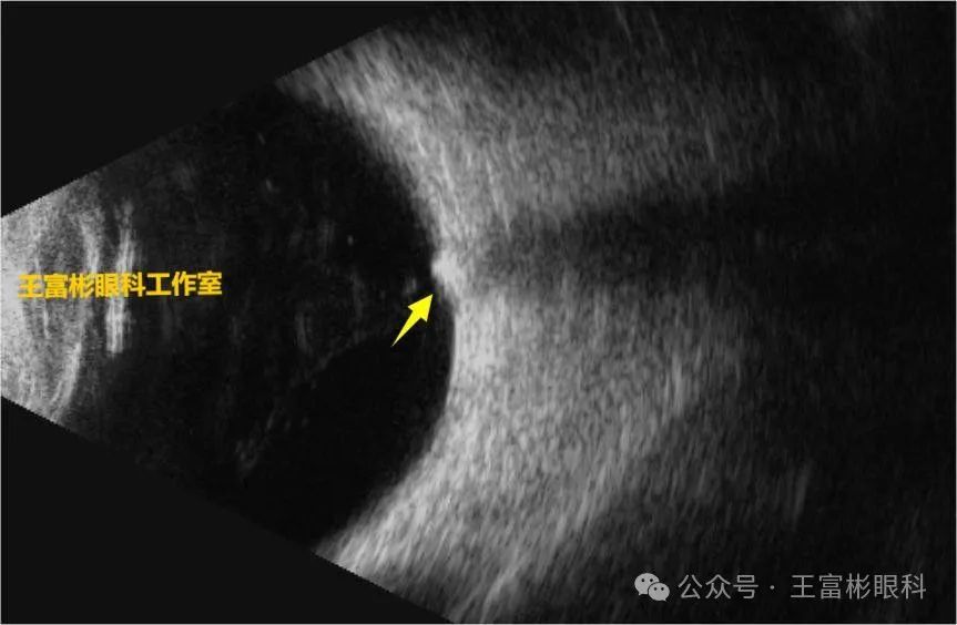 视盘玻璃膜疣（ODD）与PHOMS的影像学鉴别