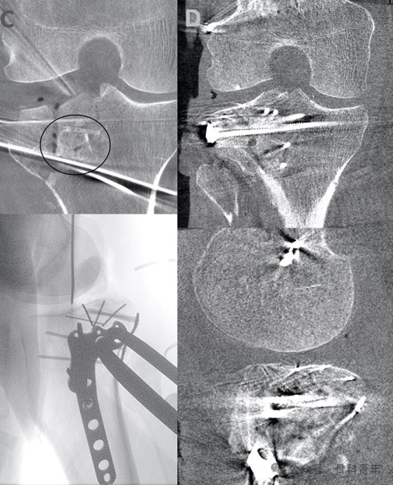 手术技巧｜外侧扩大入路联合股骨髁截骨治疗胫骨平台骨折