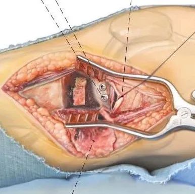 手术技巧｜外侧扩大入路联合股骨髁截骨治疗胫骨平台骨折
