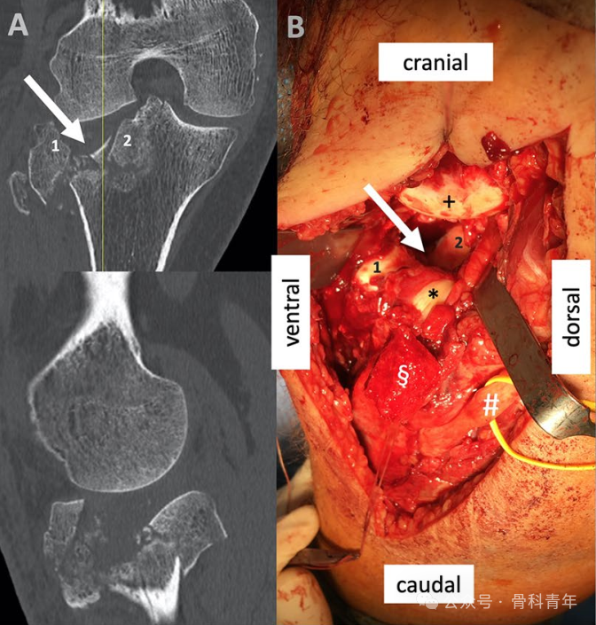 手术技巧｜外侧扩大入路联合股骨髁截骨治疗胫骨平台骨折