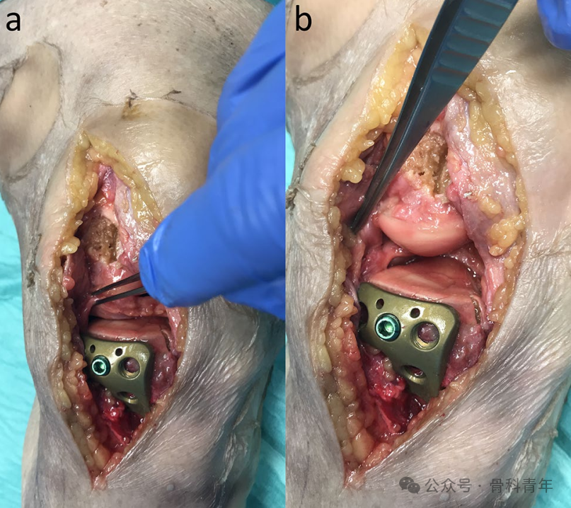 手术技巧｜外侧扩大入路联合股骨髁截骨治疗胫骨平台骨折
