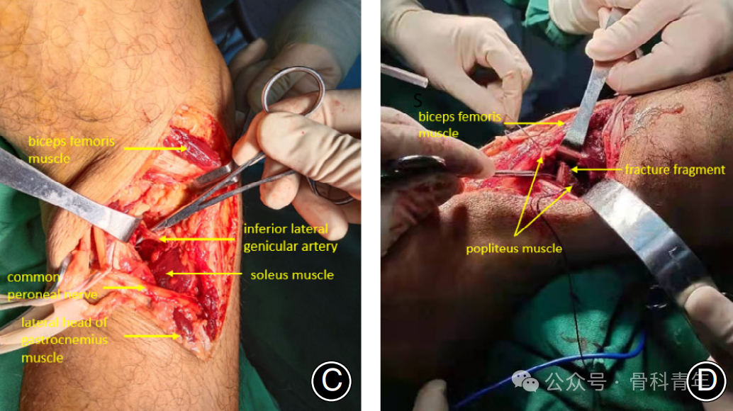 手术技巧｜外侧扩大入路联合股骨髁截骨治疗胫骨平台骨折