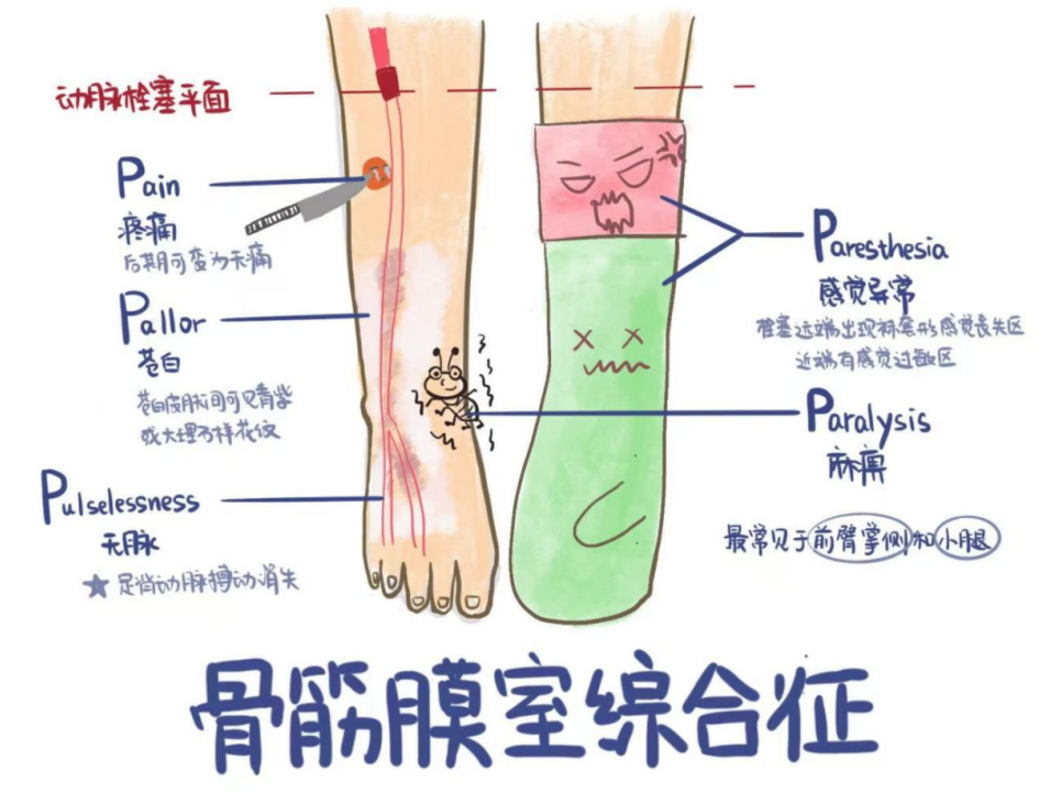 儿童骨筋膜室综合征，你知道什么处理吗？