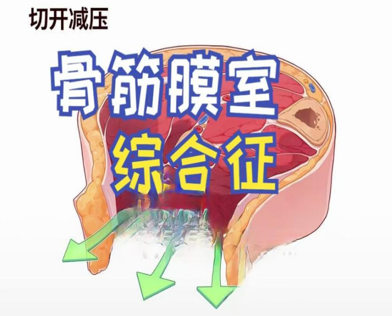 儿童骨筋膜室综合征，你知道什么处理吗？