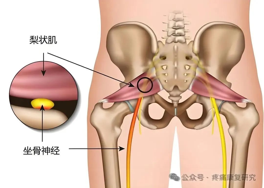 臀部疼痛是咋回事？重点关注这