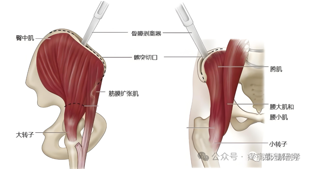 臀部疼痛是咋回事？重点关注这