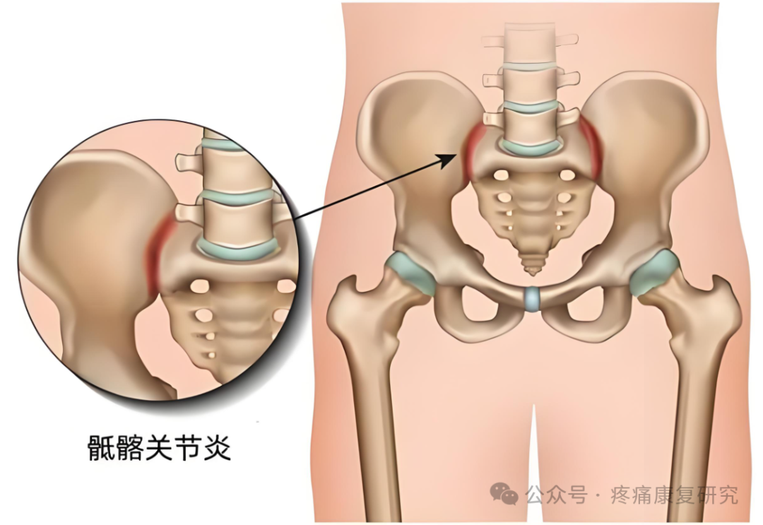 臀部疼痛是咋回事？重点关注这