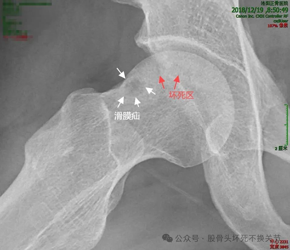 股骨头坏死最省事的康复方法