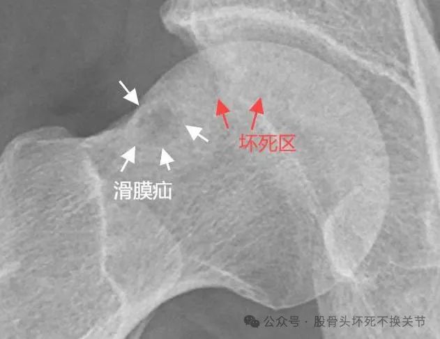 股骨头坏死最省事的康复方法