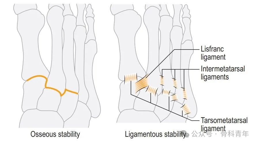 手术技巧｜介绍2种弹性固定Lisfranc损伤的方法