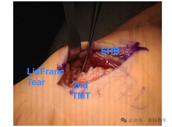 手术技巧｜介绍2种弹性固定Lisfranc损伤的方法