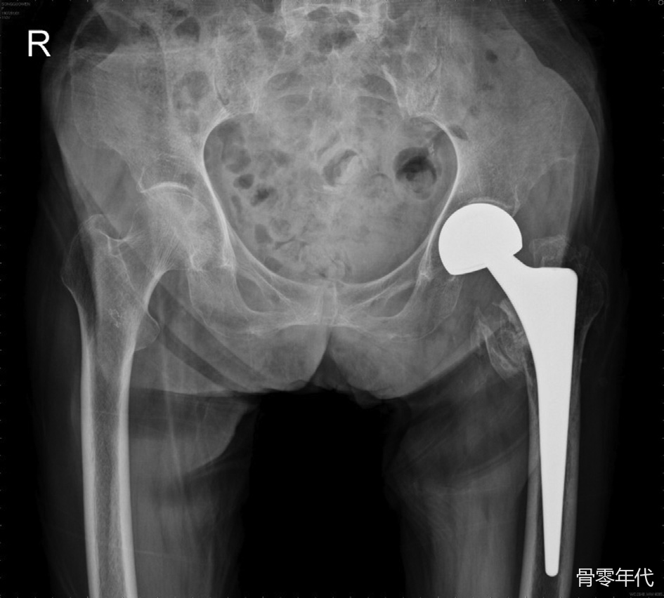 为一名109岁高龄股骨转子间骨折患者实施半髋关节置换术