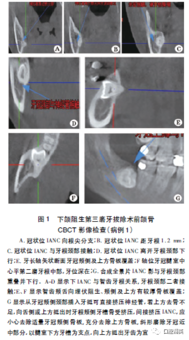 下颌阻生第三磨牙拔除后下牙槽神经永久损伤2例影像特点