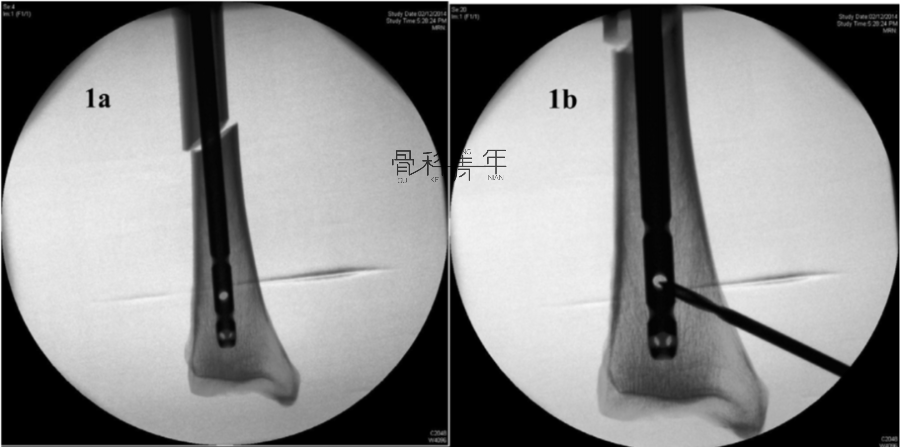 重温经典：阻挡钉（Poller钉）怎么打？