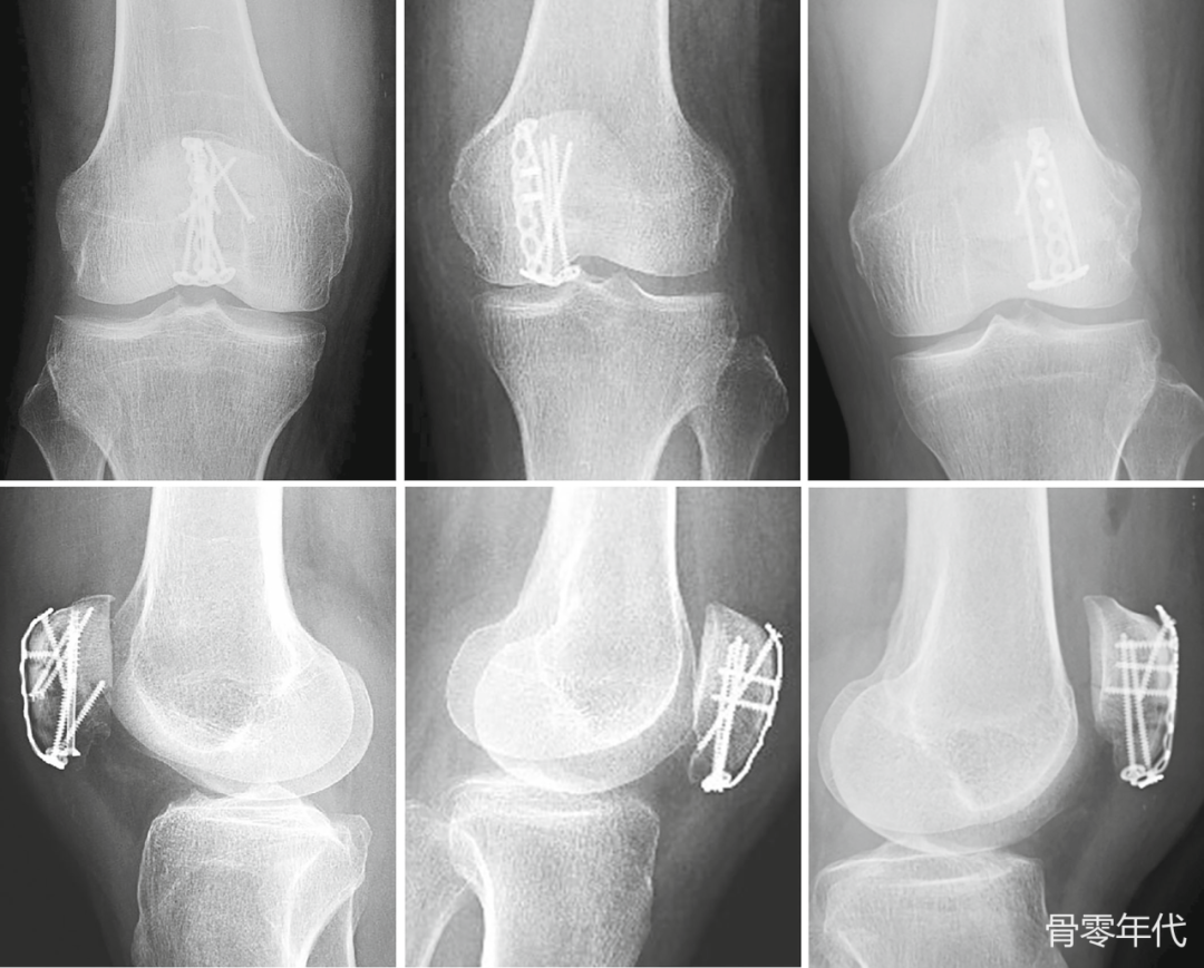 手部钢板治疗髌骨下极骨折