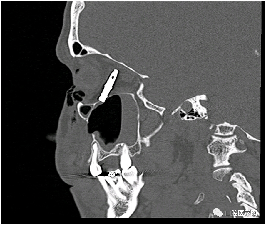 可怕！种植体，没在上颌窦，但在眼球后！