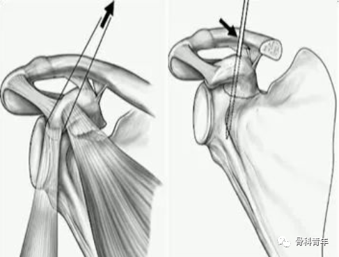 肩关节“灯塔”｜喙突骨折的解剖、分型与治疗