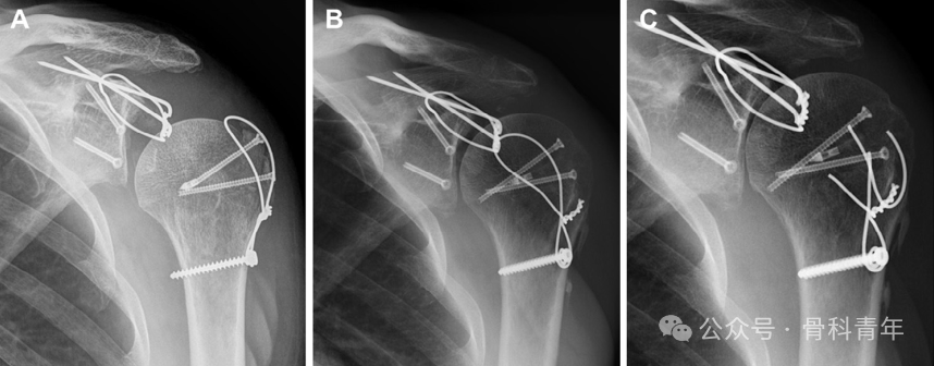 肩关节“灯塔”｜喙突骨折的解剖、分型与治疗
