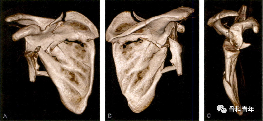 肩关节“灯塔”｜喙突骨折的解剖、分型与治疗