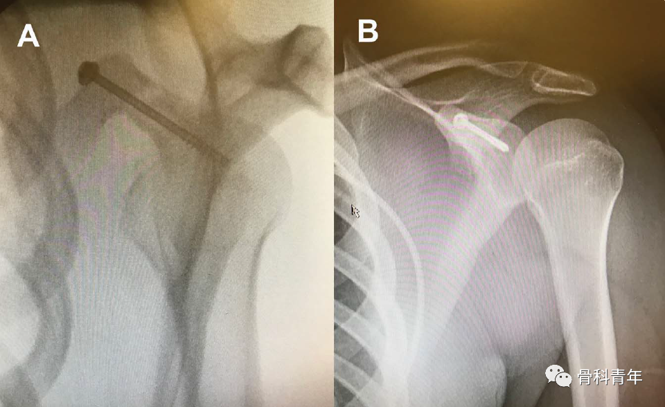 肩关节“灯塔”｜喙突骨折的解剖、分型与治疗