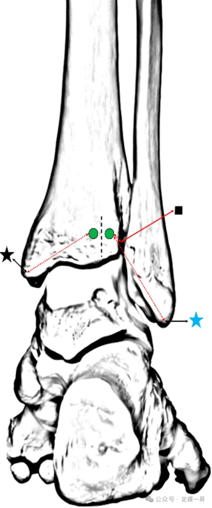 ​经皮穿跟腱螺钉固定后踝骨折的操作安全区