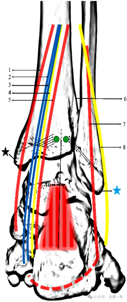 ​经皮穿跟腱螺钉固定后踝骨折的操作安全区