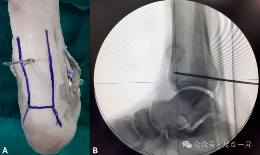 ​经皮穿跟腱螺钉固定后踝骨折的操作安全区