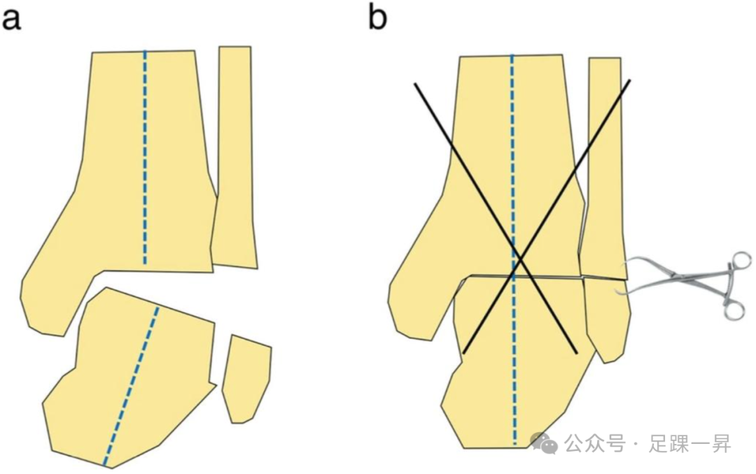 手术技巧｜微创经腓骨入路踝关节融合术