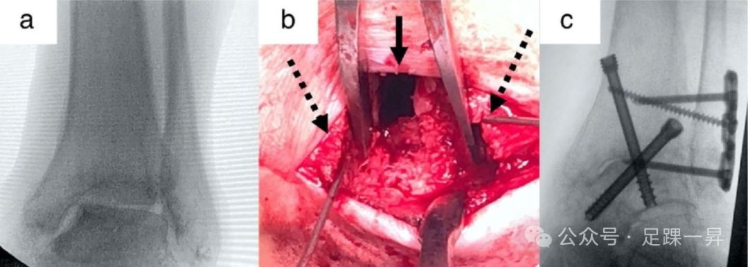 手术技巧｜微创经腓骨入路踝关节融合术